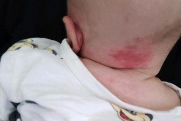 红胎记算命图解