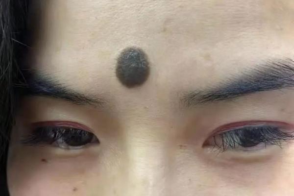 算命胎记 算命胎记