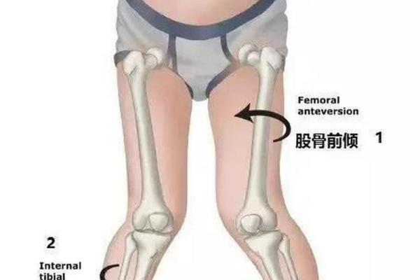 小孩走路内八字 小孩走路内八字
