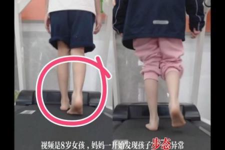 小孩走路内八字