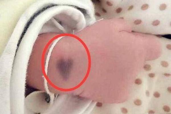 腰部上的胎记如何算命分析？