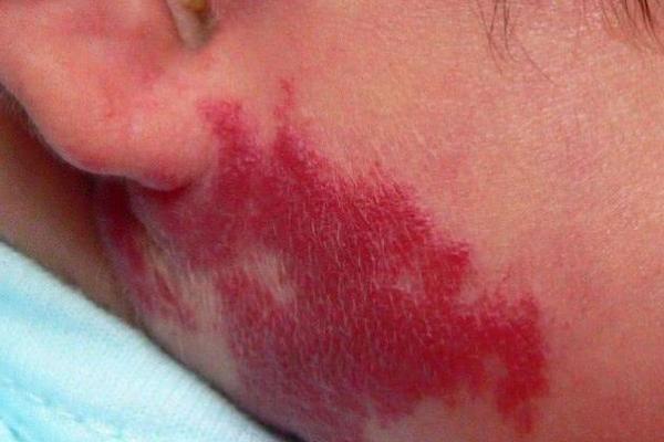 红色的胎记算命