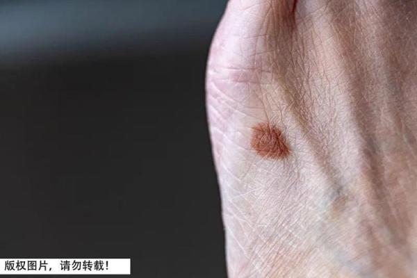 算命黑色胎记