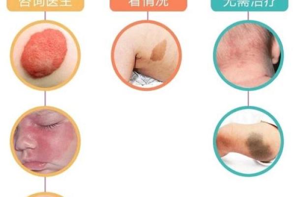 胎记算命的方法