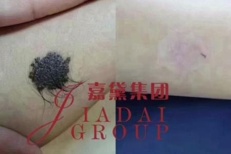 算命黑色胎记