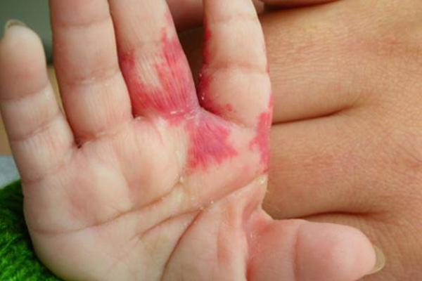 胎记算命胎记的位置与命运 胎记算命胎记的位置与命运