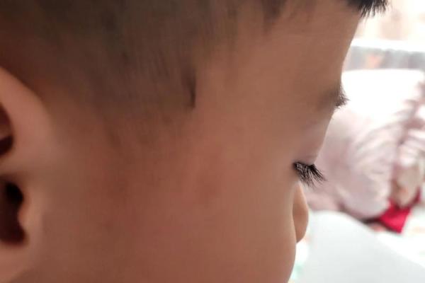 胎记算命胎记的位置与命运 胎记算命胎记的位置与命运