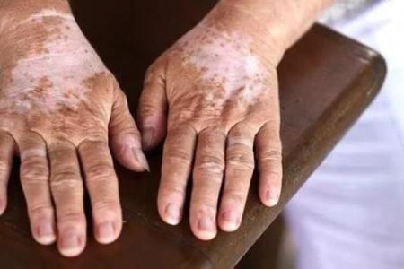 白色胎记算命分析