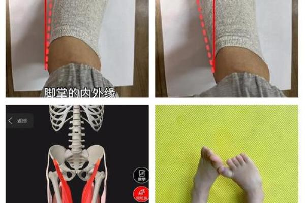 矫正内八字 矫正内八字