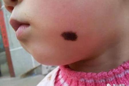 屁股有胎记算命分析